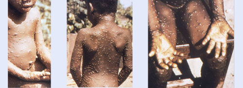 monkeypox images