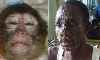 monkey-pox-in-nigeria